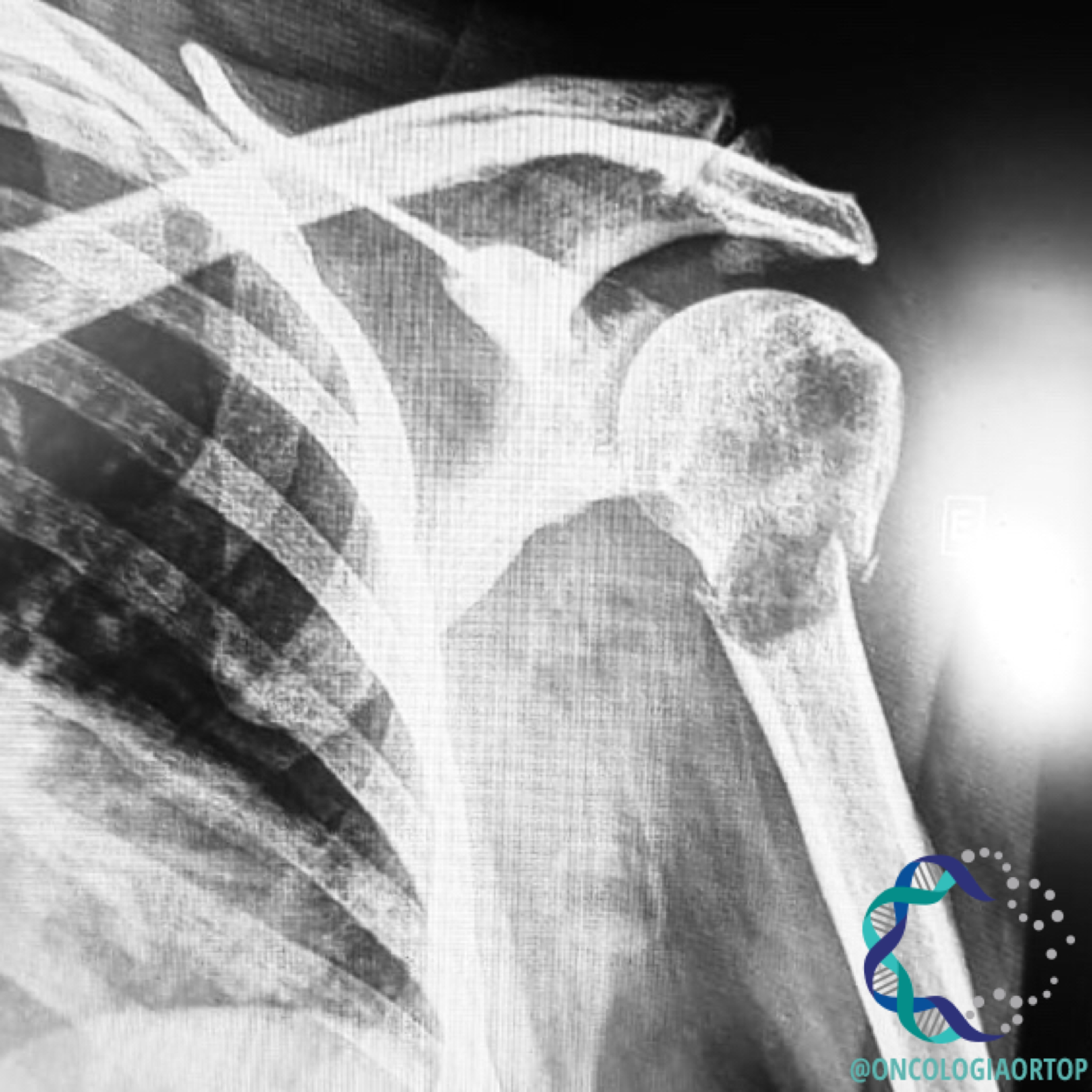fratura-patologica-pathological-fracture-of-the-jaw-due-to