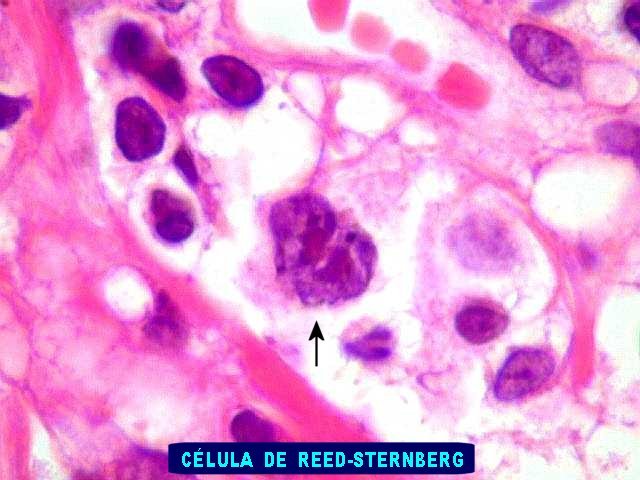 LINFOMA DE HODGKIN CLÁSSICO - Oncologia Ortopédica