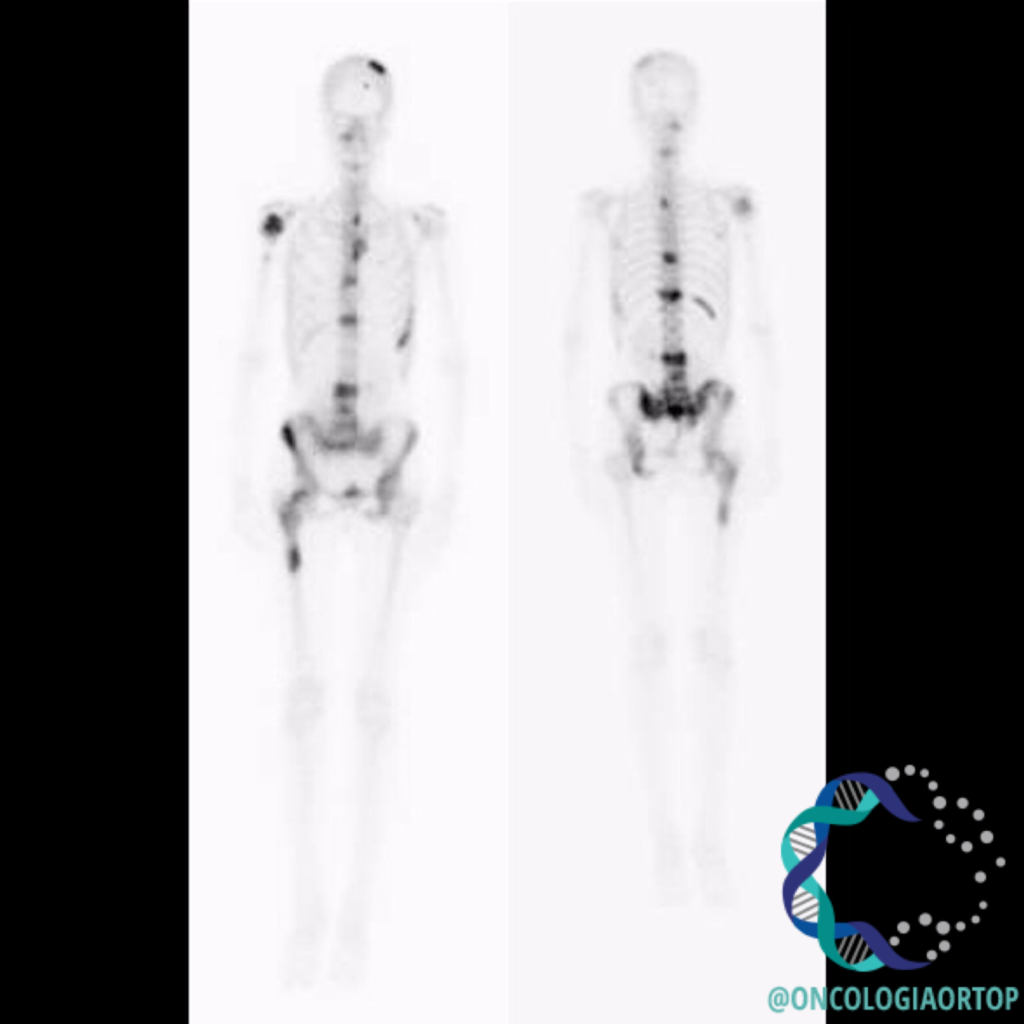 METÁSTASE PARA OS OSSOS NO PACIENTE COM CÂNCER Oncologia Ortopédica METÁSTASE PARA OS OSSOS NO PACIENTE COM CÂNCER Oncologia Ortopédica