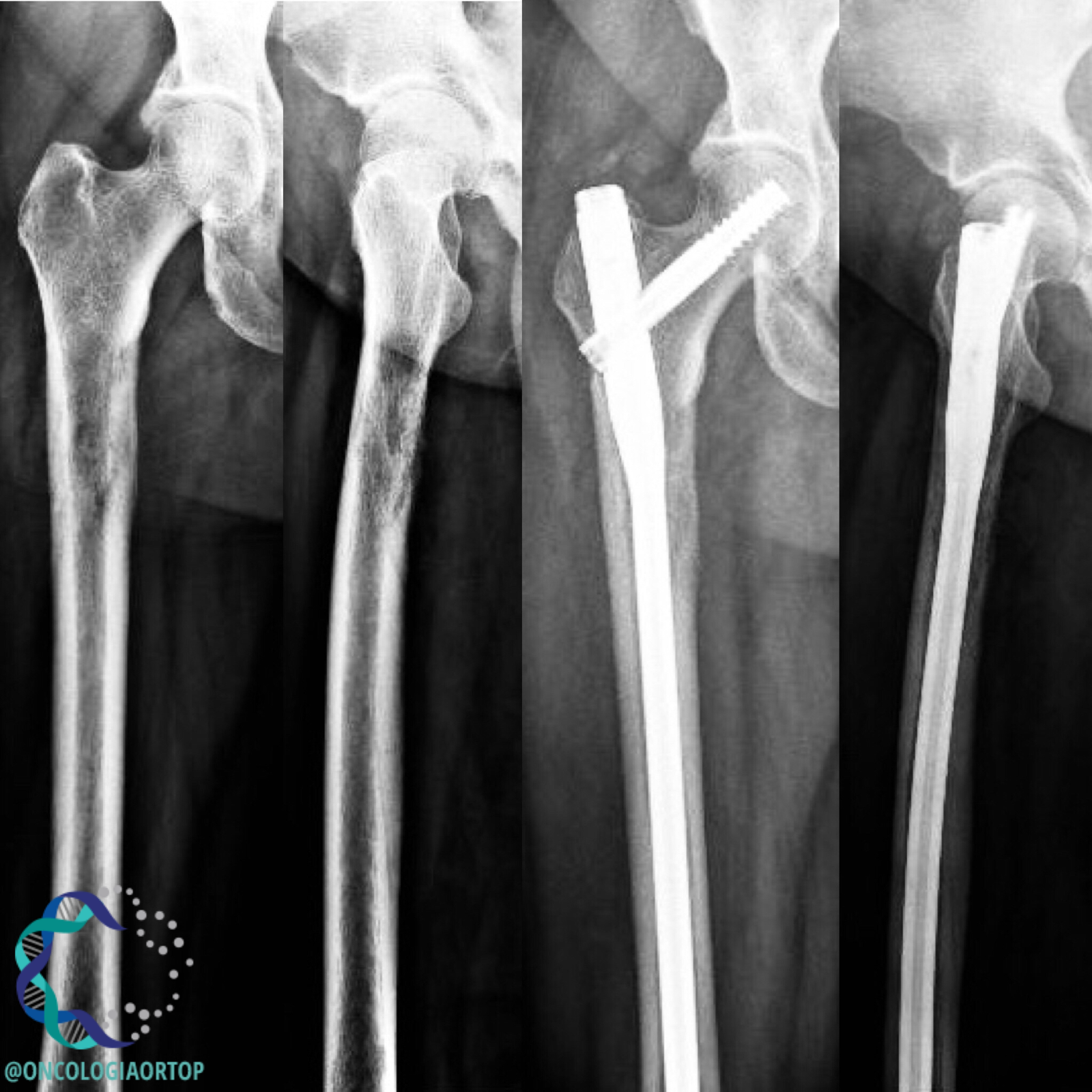 METÁSTASE PARA OS OSSOS NO PACIENTE COM CÂNCER - Oncologia Ortopédica